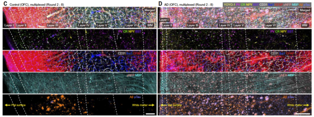 Panel of images showing layers of brain cells in Alzheimer's disease and a healthy control.
